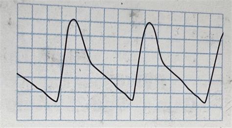 Indirect Assessment Of LE Arterial Disease Flashcards Quizlet