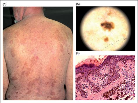 Eruptive Melanocytic Nevi In A Patient With Toxic Epidermal Necrolysis