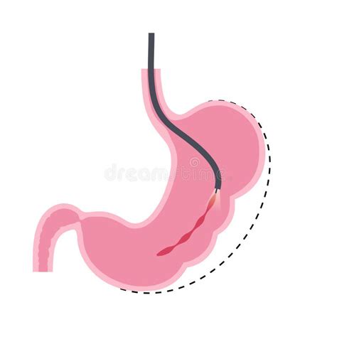 Gastric Sleeve Surgery Stock Illustrations 158 Gastric Sleeve Surgery