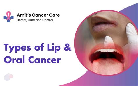 Most Common Types Of Lip Oral Cancers Dr Amit Chakraborty