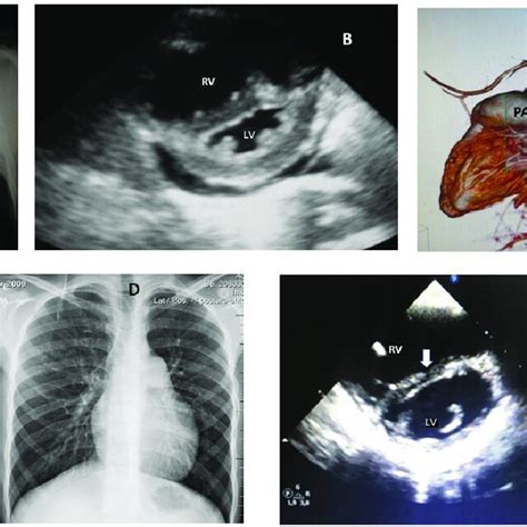 Case Number Preoperative A And Postoperative D Chest