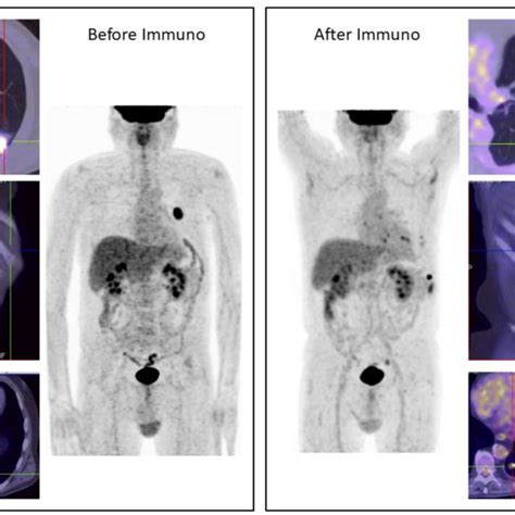 Summary of clinical trials about immunotherapy in lung cancer ...