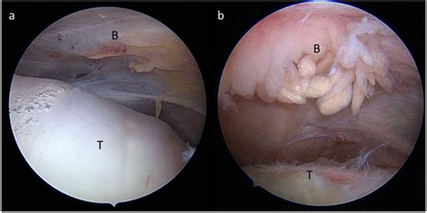 Cortisone Injections For Shoulder Pain Uses Results Side Effects