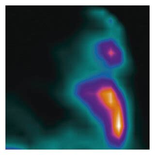 46-year-old patient with hormone receptor positive/Her2 negative ...