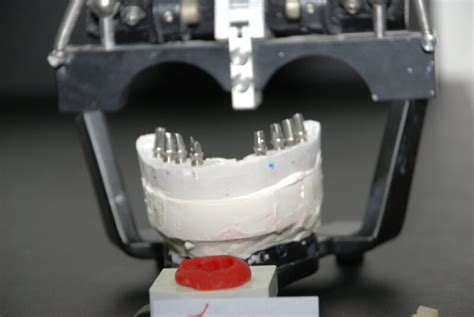 Implant Abutments And Crowns Maestro Dental Studio