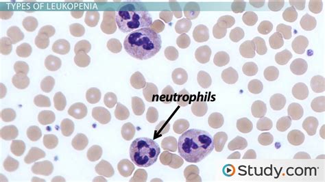 What is Leukopenia? - Causes & Types - Video | Study.com