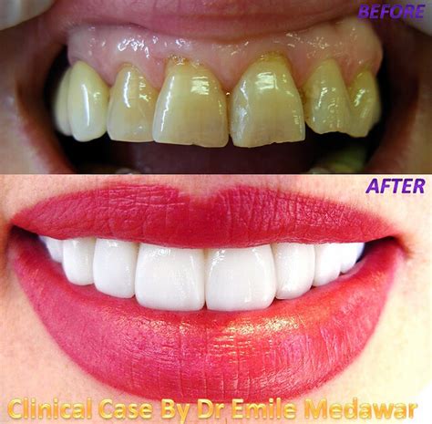 Veneers Before and After - Pictures, Popularity, Time, Color, Pros ...