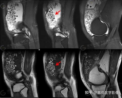 色素沉着绒毛结节性滑膜炎【西安高尚医学影像】 知乎