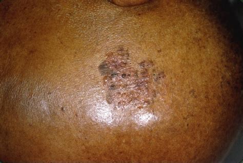 Skin Cancer Of Face