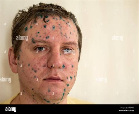 Varicella Zoster Virus Or Chickenpox Bubble Rash On Child Baby Or