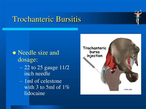 Trochanteric Bursitis Injection