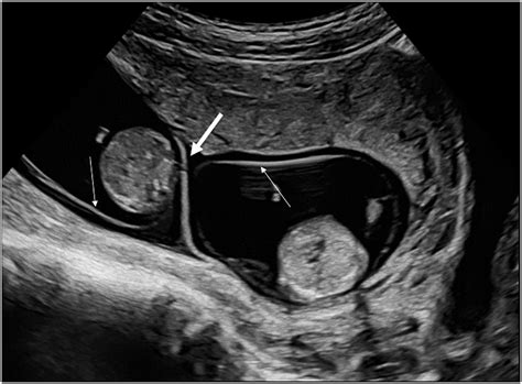 Monochorionic Diamniotic Twins What Do I Tell The Prospective Parents