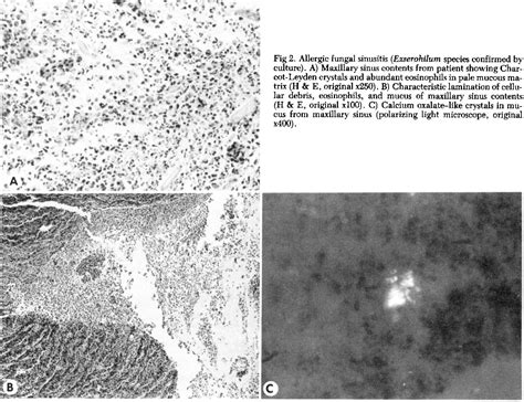 Figure 2 From Sinus Aspergillosis And Allergic Fungal Sinusitis