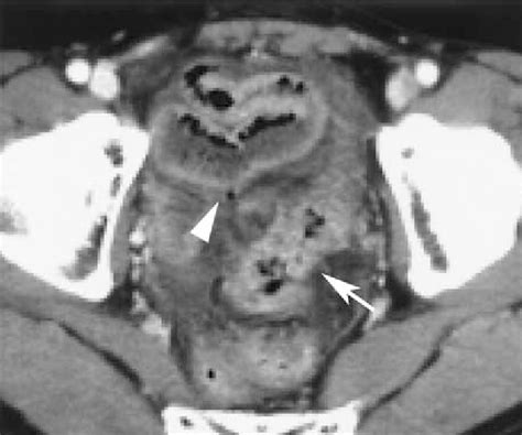 Contrast Enhanced Ct Image Of Sigmoid Colon Perforation Caused By Download Scientific Diagram