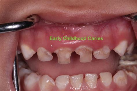 Treating Early Childhood Caries In Brisbane