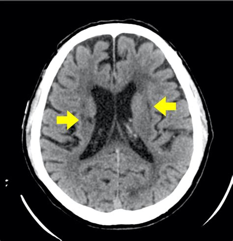 Incidental Finding Of Persistent Trigeminal Artery In A Patient With