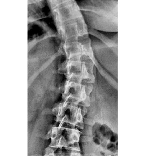 Antero Posterior Radiographic View Of Idiopathic Scoliosis Of The