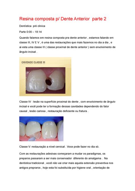 Resina Composta Dente Anterior Parte 2 Oficial Resina Composta Dente