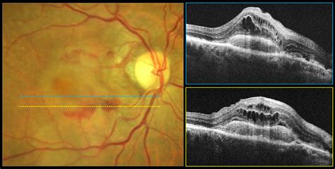 Retinal Vasculature May Affect Amd Progression