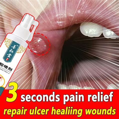 3 Seconds Pain Relief Canker Sore Spray 50ml Mouth Ulcer Treatment Canker Mouth Sore Solution