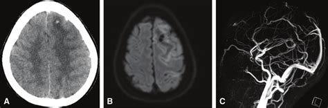 A Ct Of The Brain Showing A Low Density Area In The Left Frontal Lobe