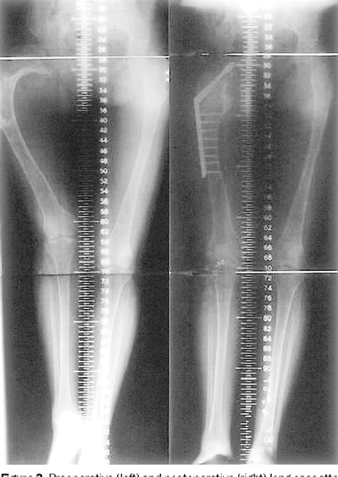 Figure From Shepherd S Crook Deformity Of Polyostotic Fibrous