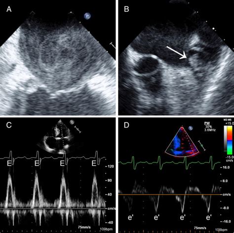 Representative Examples A Left Atrial Spontaneous Echo Contrast Download Scientific Diagram