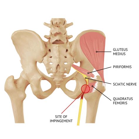 Ischial Pain When Sitting