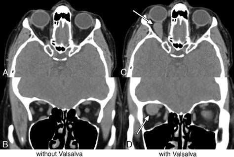 Orbital Varix A Year Old Woman Who Presented Due To An Orbital Mass