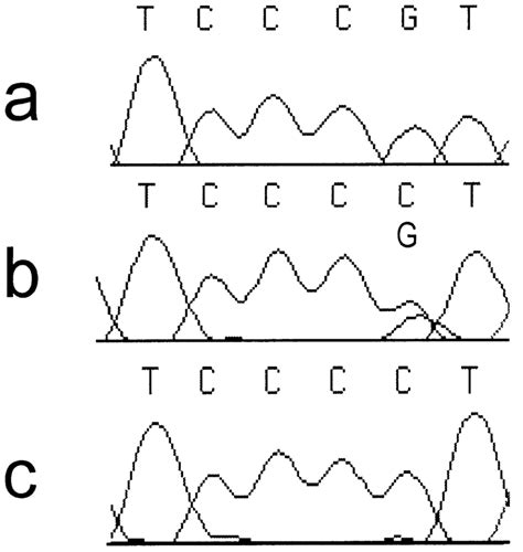 Chromatograms From Dna Sequencing Demonstrating A C1043g Transition In