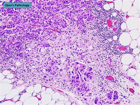 Qiaos Pathology Primary Peritoneal Serous Carcinoma Flickr