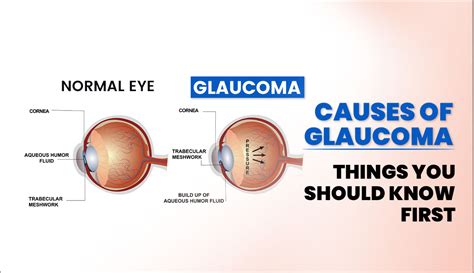 What Are The Causes Of Glaucoma Things You Must Know