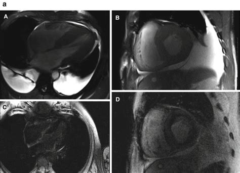 Multimodality Imaging Of Cardiac Amyloidosis Radiology Key