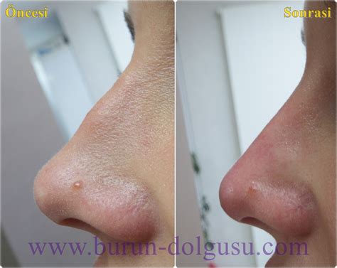 Health Zone Turkey Non Surgical Nose Job With Filler In Istanbul Turkey