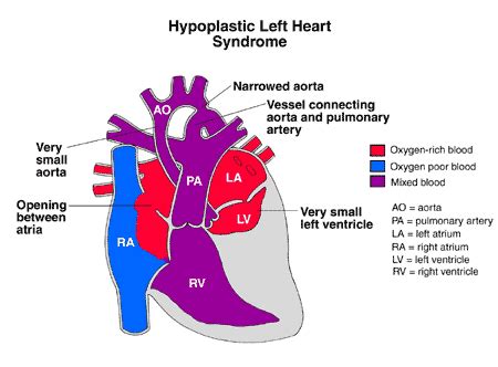 Hypoplastic Left Heart Syndrome (HLHS) | Prognosis & Treatment ...