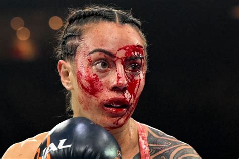 World champ Cherneka Johnson shows off horror gash and left bloodied ...