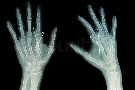 Film X Ray Of Hand Fracture Show Fracture Metacarpal Bone Insert With