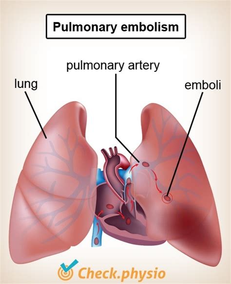 Pulmonary Embolism Physio Check