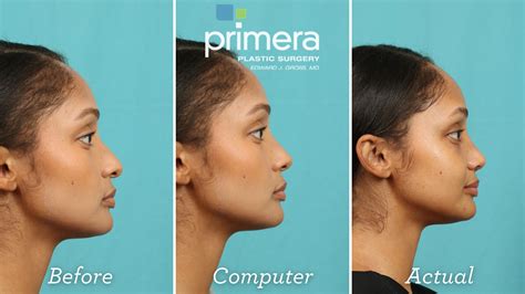 Predicting Rhinoplasty Results With Computer Imaging Primera Plastic