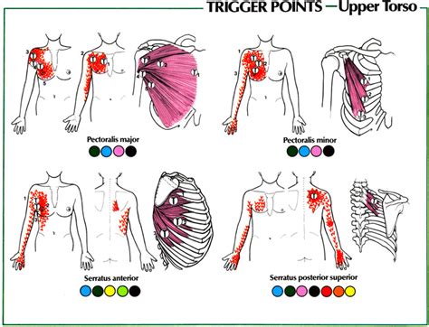 Карта триггерных точек с отраженными болями для распечатывания ...