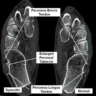 Coronal CT scan view showing the enlarged peroneal tubercle. | Download ...