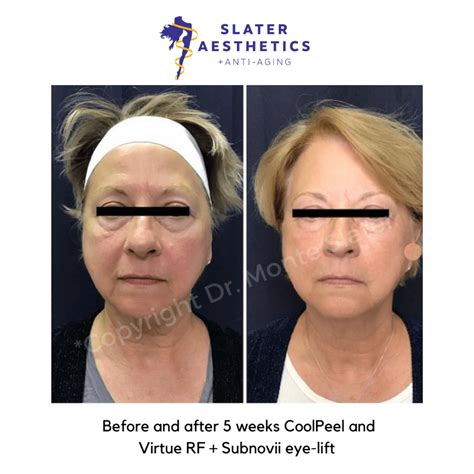 Experience Virtue RF CoolPeel At Slater Aesthetics