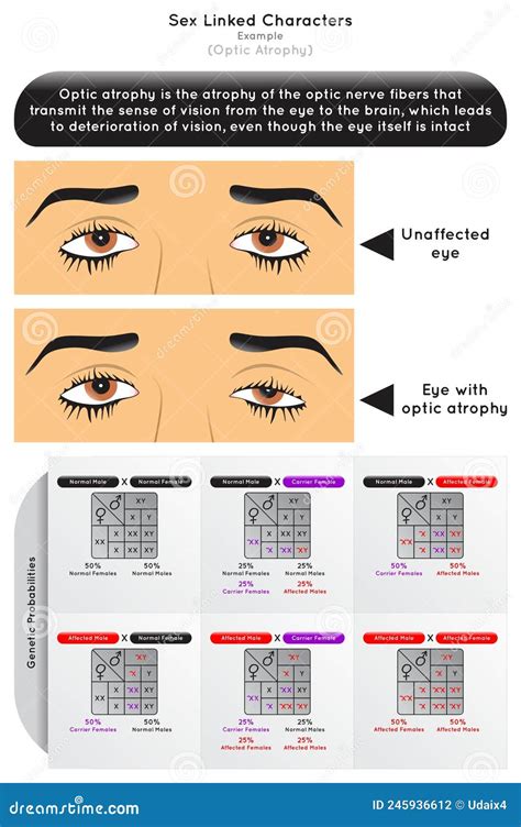 Sex Linked Characters Infographic Diagram With Example Of Optic Atrophy