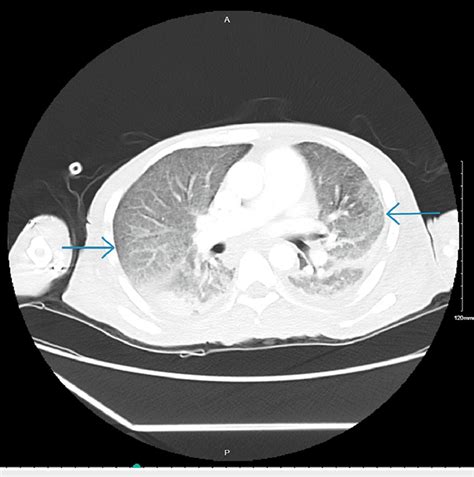 CT Chest With Contrast Showing Diffuse Bilateral Groundglass Opacities