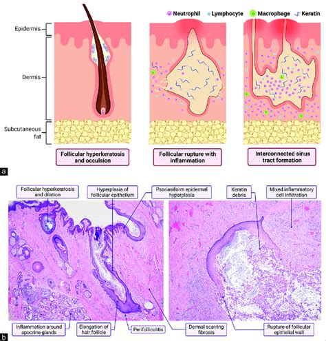 Pathogenesis And Histopathology Of Hidradenitis Suppurativa A The