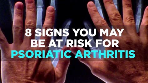 8 Signs You May Be At Risk For Psoriatic Arthritis YouTube