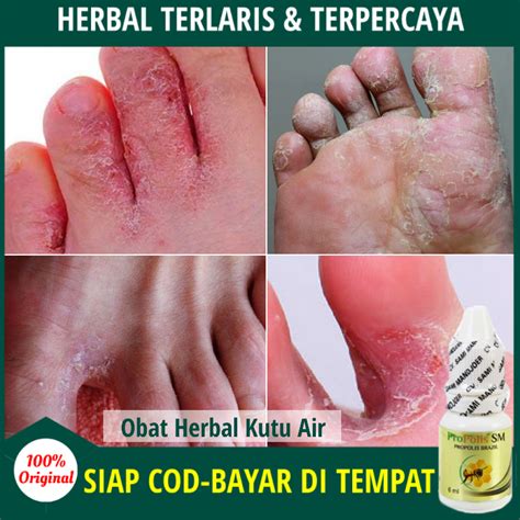 Kutu Air Di Telapak Kaki – newstempo