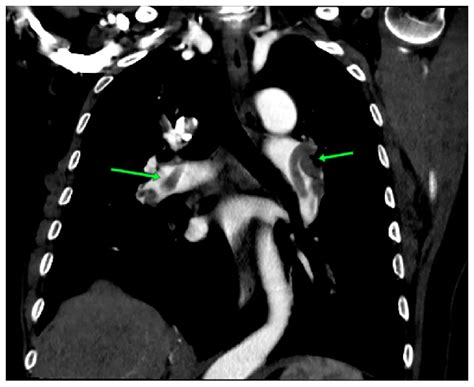 Computed Tomography Pulmonary Angiography Axial Section Indicating