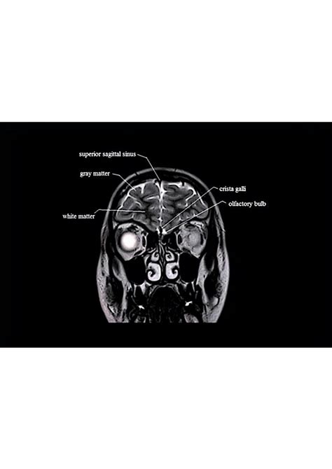 SOLUTION: Mri coronal view of brain - Studypool