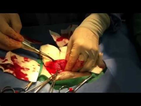 Cystotomy YouTube